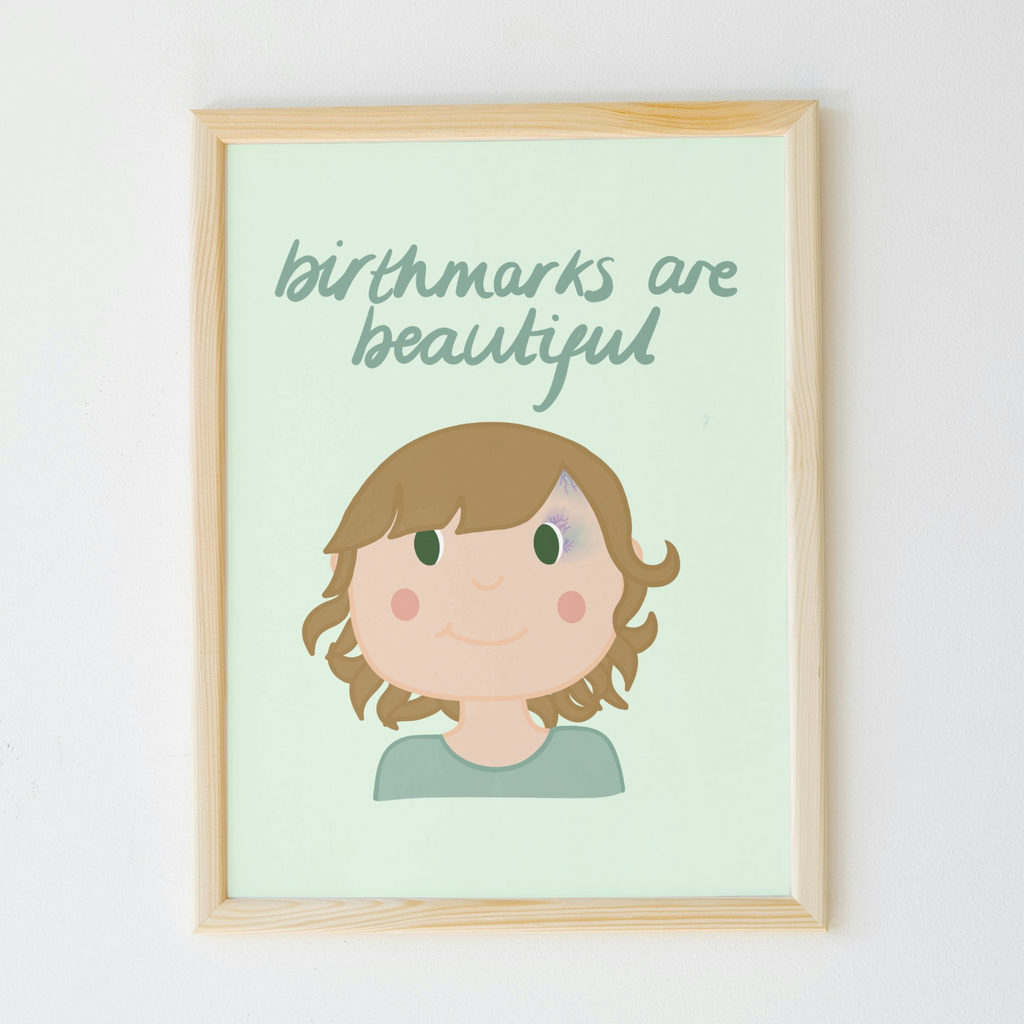 Birthmarks are Beautiful Print
