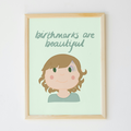 Birthmarks are Beautiful Print